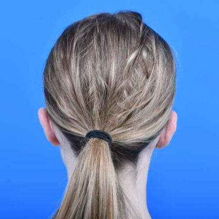 After image 4 Case #126226 - Otoplasty 14 year old