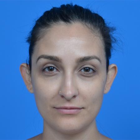 Before image 1 Case #126236 - otoplasty 27 year old woman