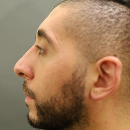 Before image 2 Case #126831 - Rhinoplasty