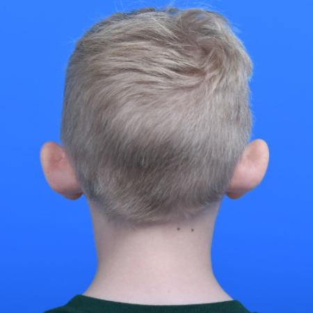 Before image 4 Case #126166 - Otoplasty