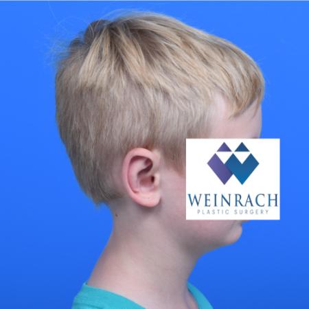 After image 3 Case #126166 - Otoplasty