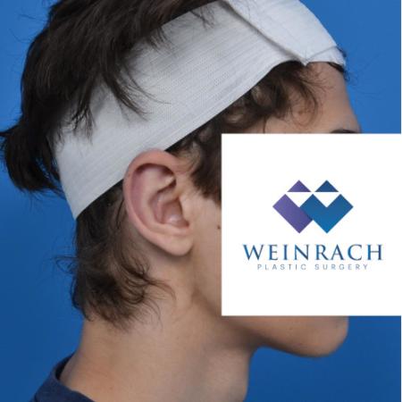 After image 3 Case #126231 - Otoplasty 18 year old