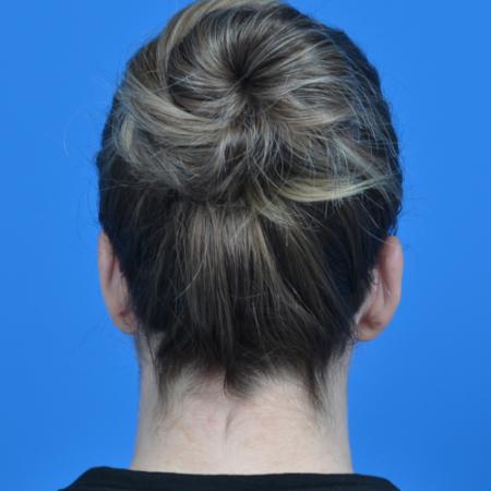 After image 4 Case #126576 - otoplasty 31 year old woman