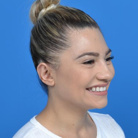 After image 2 Case #126176 - otoplasty and earlobe repair