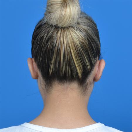 After image 4 Case #126176 - otoplasty and earlobe repair
