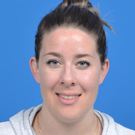 Before image 1 Case #126576 - otoplasty 31 year old woman