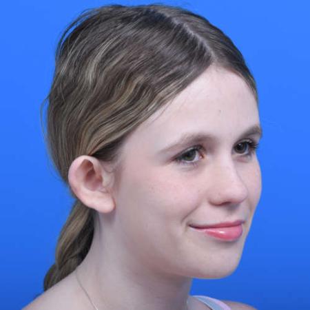 Before image 2 Case #126226 - Otoplasty 14 year old