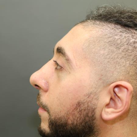 After image 2 Case #126831 - Rhinoplasty