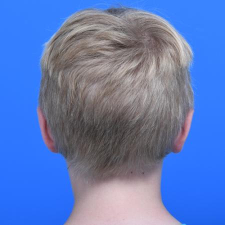 After image 4 Case #126166 - Otoplasty