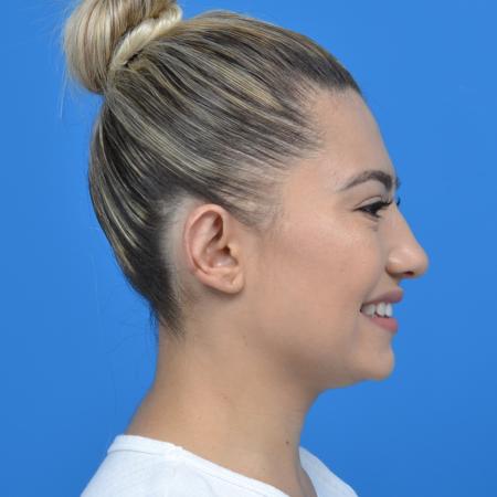 After image 3 Case #126176 - otoplasty and earlobe repair