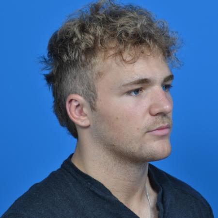 After image 2 Case #126566 - Otoplasty 19 year old