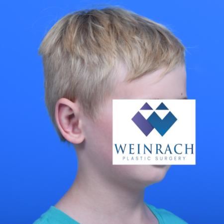 After image 2 Case #126166 - Otoplasty