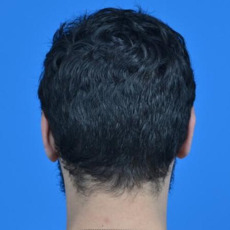 After image 4 Case #126571 - Otoplasty 32 year old