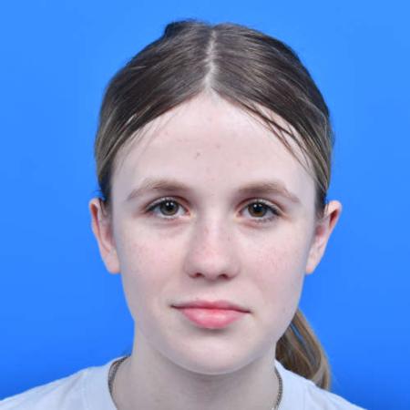 After image 1 Case #126226 - Otoplasty 14 year old