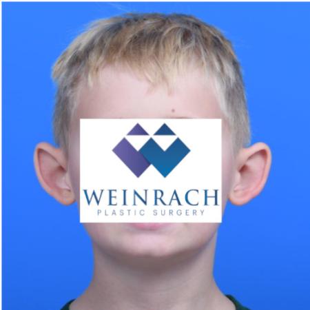 Before image 1 Case #126166 - Otoplasty