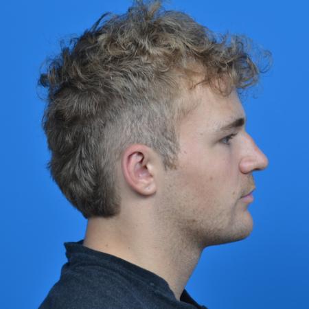 After image 3 Case #126566 - Otoplasty 19 year old