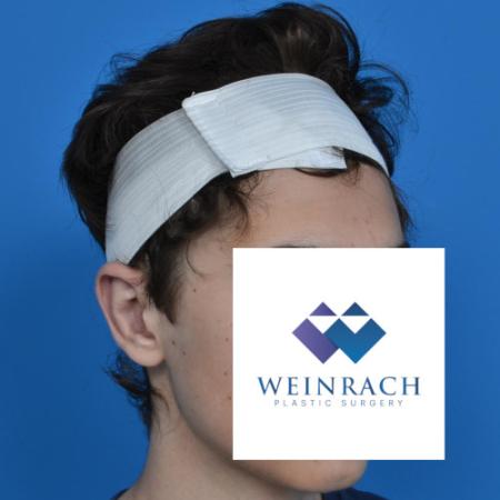 After image 2 Case #126231 - Otoplasty 18 year old