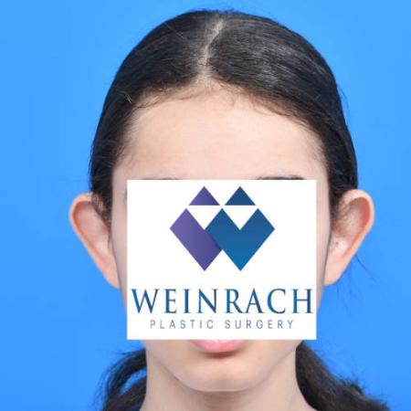 Before image 1 Case #126221 - Otoplasty 11 year old