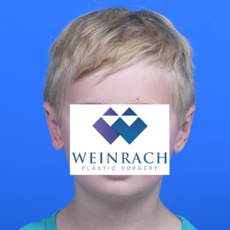 After image 1 Case #126166 - Otoplasty