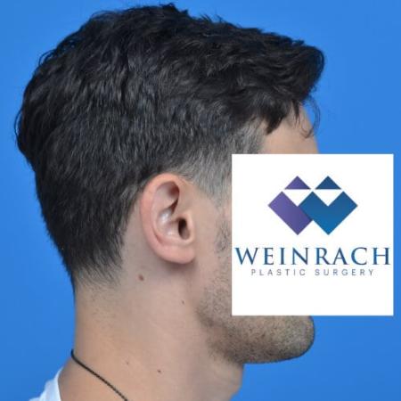 Before image 3 Case #126571 - Otoplasty 32 year old