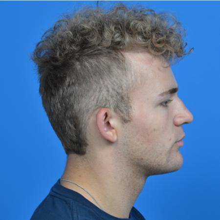 Before image 3 Case #126566 - Otoplasty 19 year old