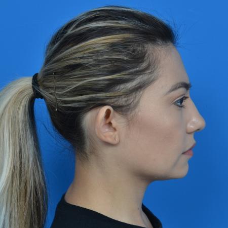 Before image 3 Case #126176 - otoplasty and earlobe repair