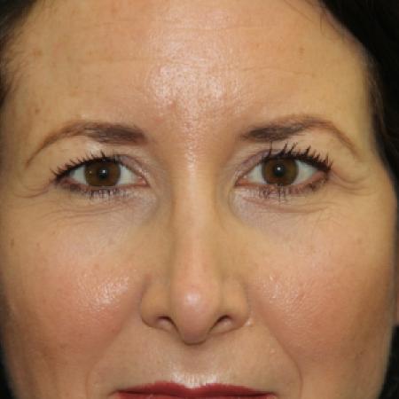 Before image 1 Case #126861 - Blepharoplasty and Brow lift. 