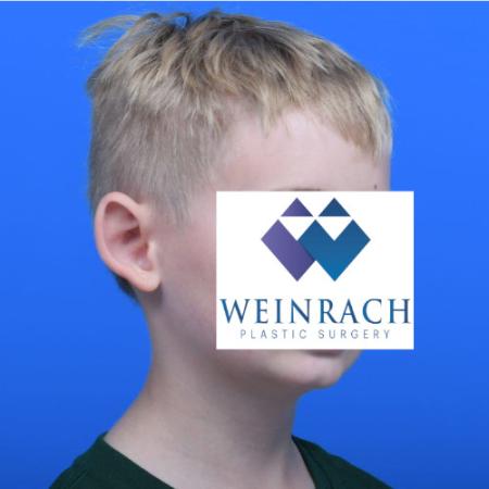 Before image 2 Case #126166 - Otoplasty