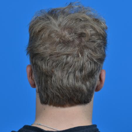 After image 4 Case #126566 - Otoplasty 19 year old