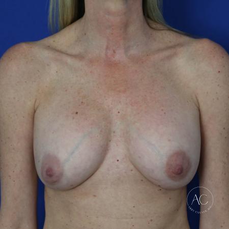 Before image 1 Case #127511 - Breast implant exchange with lift