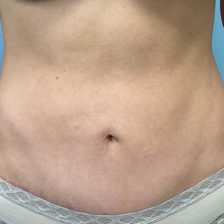 After image 1 Case #126926 - a 47 year old female; mini tummy tuck w/ lipo 360 