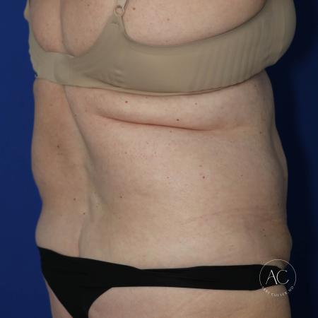 Before image 4 Case #127481 - Circumferential trunk lipo and abdominoplasty