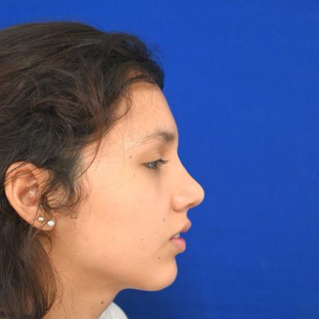 After image 3 Case #127121 - Case 1 - Rhinoplasty 