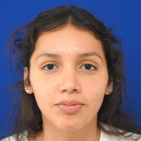 After image 1 Case #127121 - Case 1 - Rhinoplasty 