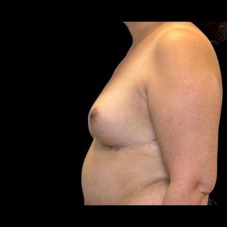After image 5 Case #126951 - Revision mastopexy