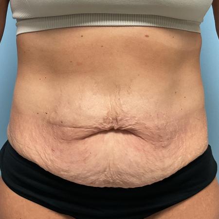 Before image 1 Case #127266 - 43 y.o. female w/ abdominoplasty & lipo of flanks
