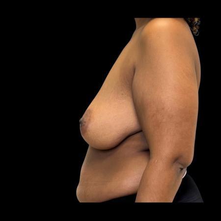 Before image 5 Case #126946 - Mastopexy without Implants 