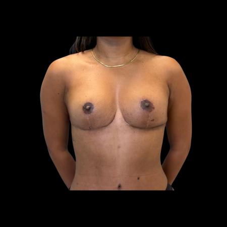 After image 1 Case #126936 - Mastopexy Without Implants 