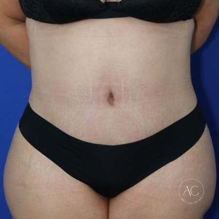 After image 1 Case #127456 - Circumferential trunk lipo and abdominoplasty