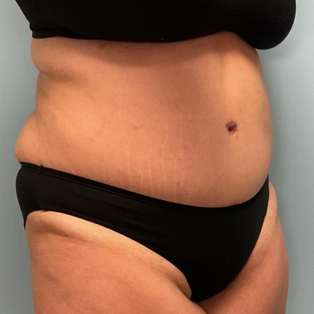 After image 2 Case #127386 - 35 y.o. female w/ Tummy Tuck & Lipo of flanks 