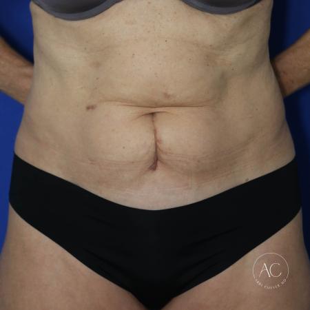Before image 1 Case #127496 - Abdominoplasty