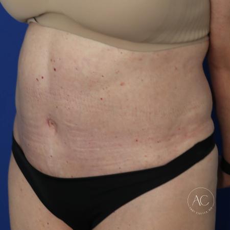 After image 2 Case #127481 - Circumferential trunk lipo and abdominoplasty