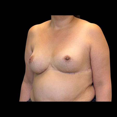 After image 4 Case #126951 - Revision mastopexy