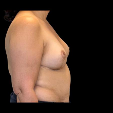 After image 3 Case #126951 - Revision mastopexy
