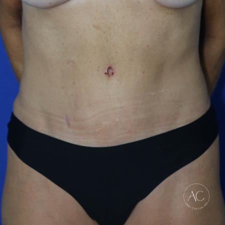 After image 1 Case #127496 - Abdominoplasty