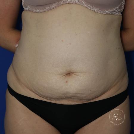 Before image 1 Case #127486 - Liposuction and abdominoplasty