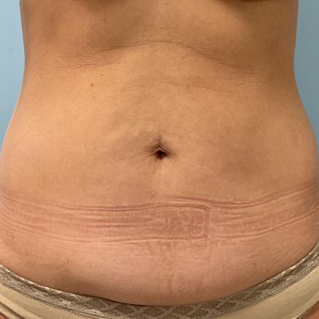 Before image 1 Case #126926 - a 47 year old female; mini tummy tuck w/ lipo 360 