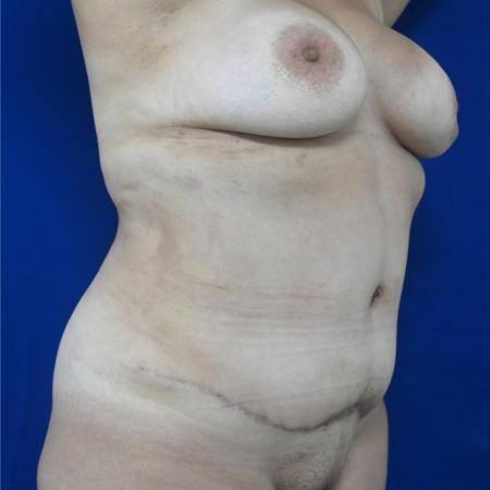 After image 2 Case #127131 - Case 3 - Lipoabdominoplasty & Breast Implants