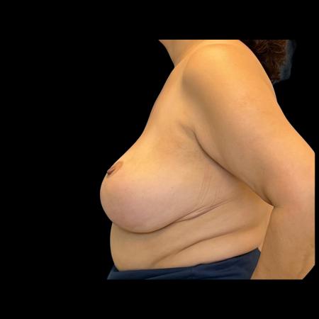 Before image 5 Case #126951 - Revision mastopexy