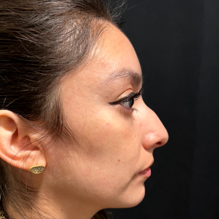 Before image 3 Case #127526 - Septoplasty